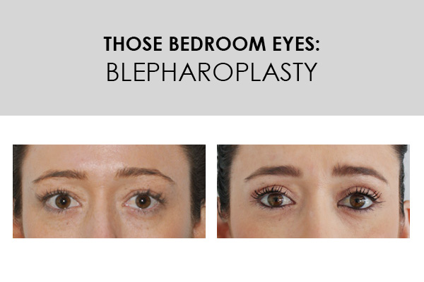 those bedroom eyes - blepharoplasty