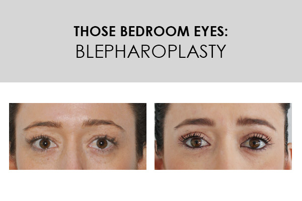 Those Bedroom Eyes Blepharoplasty