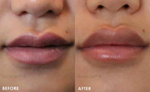 Lip Augmentation Injections Sydney Bondi Dr Mooney