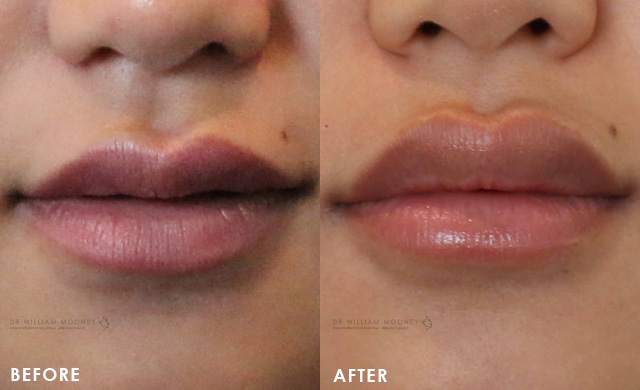 Lip Augmentation & Injections | Sydney | Bondi | Dr Mooney